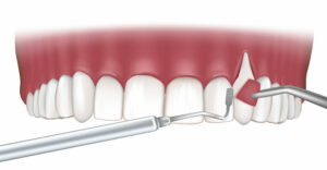 Closeup cartoon of gum graft