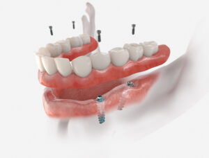 Implant retained dentures