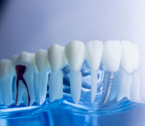 cerritos dental implants