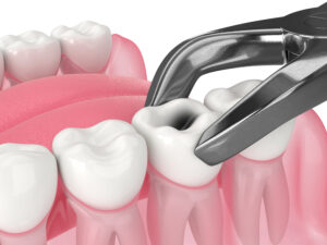 cerritos tooth extraction