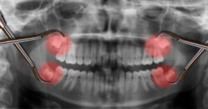 cerritos wisdom tooth extraction