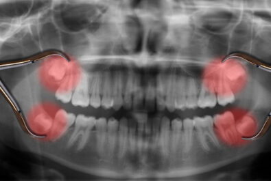 cerritos wisdom tooth extraction