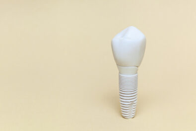 cerritos dental implants