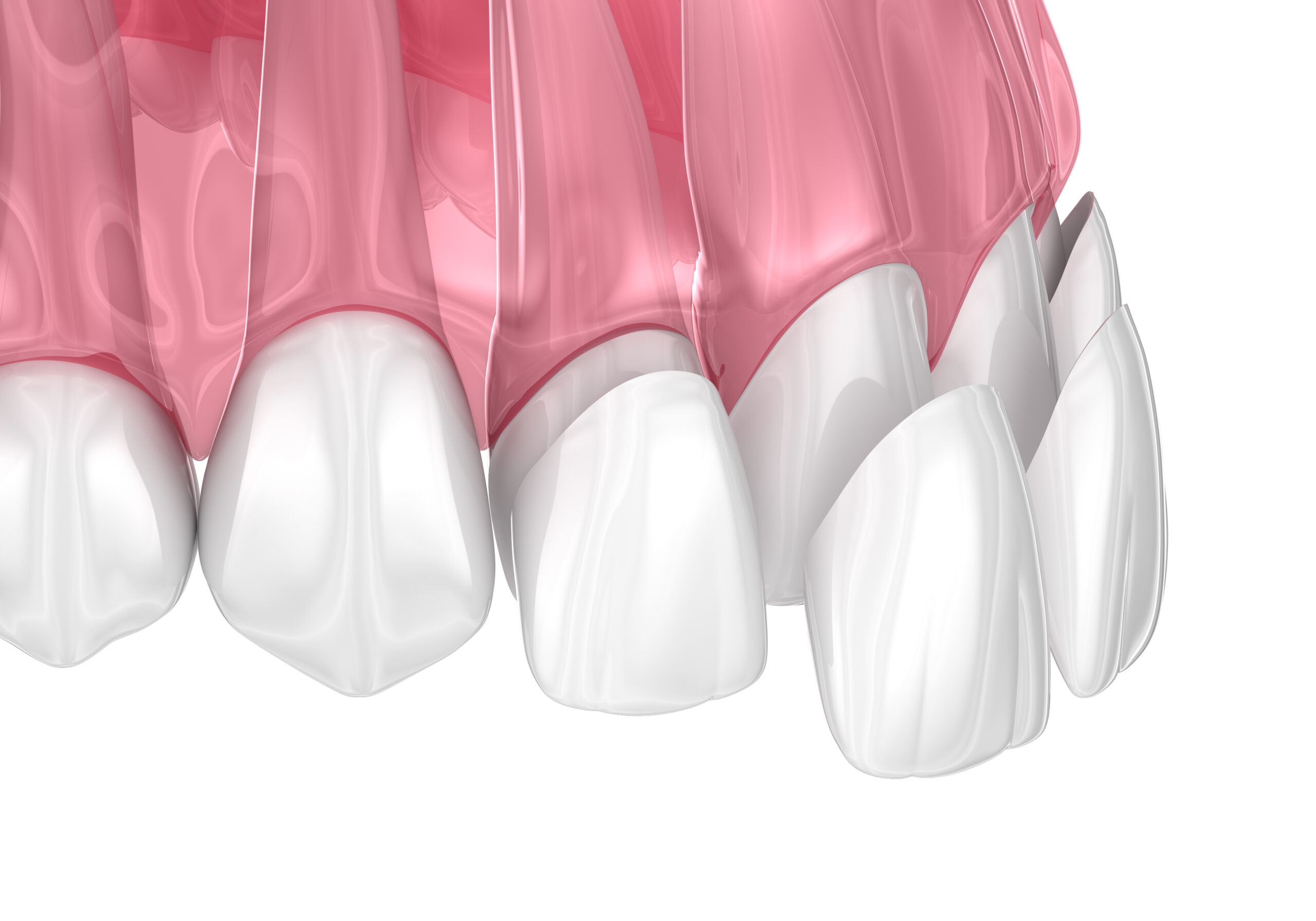 cerritos veneers