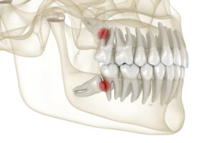 cerritos wisdom tooth extraction