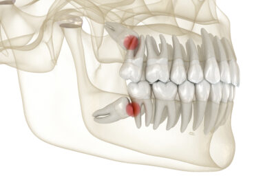 cerritos wisdom tooth extraction