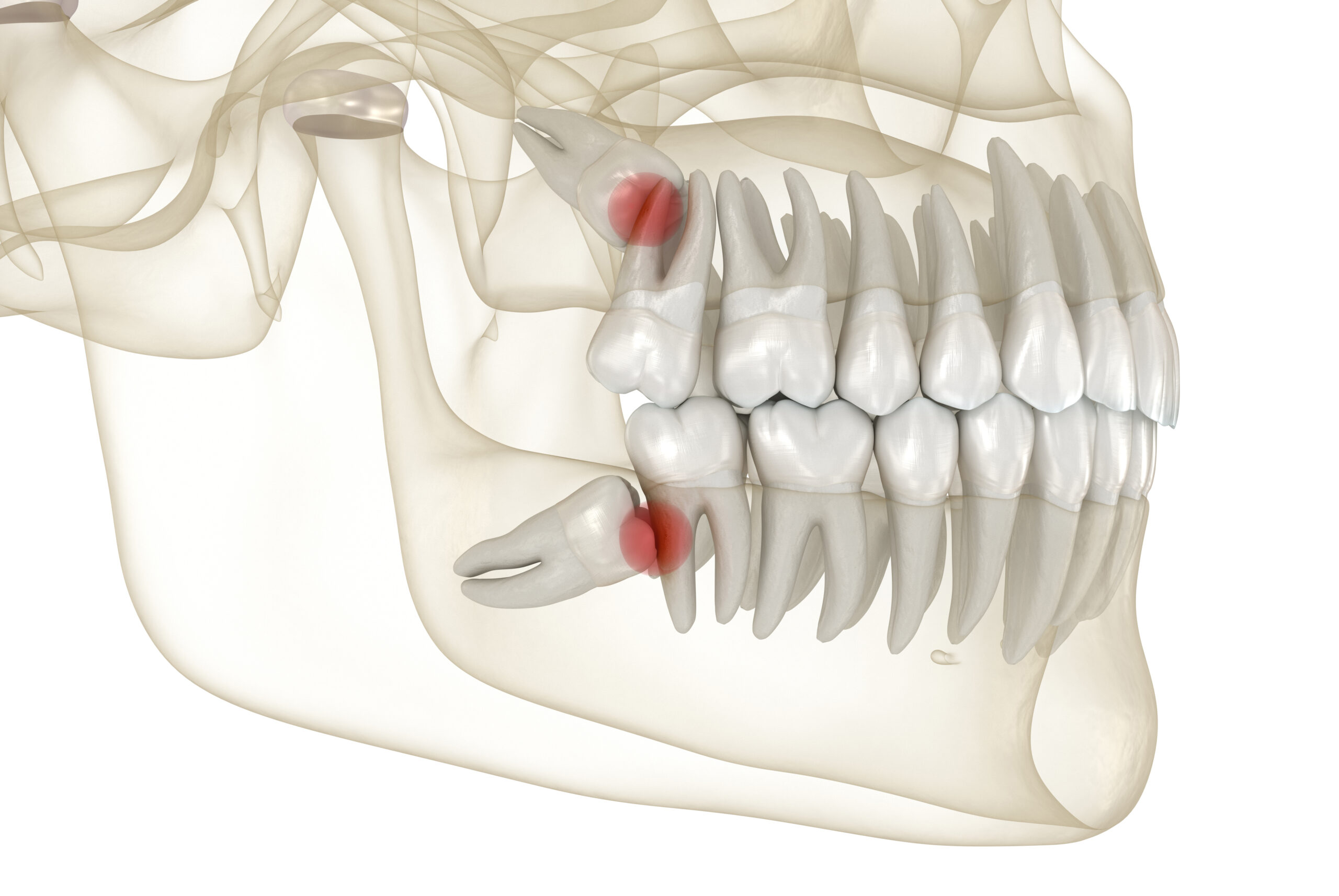 cerritos wisdom tooth extraction