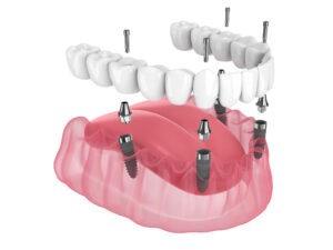 cerritos bone grafting