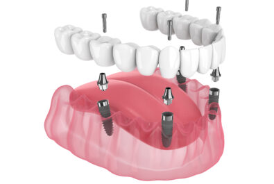 cerritos bone grafting