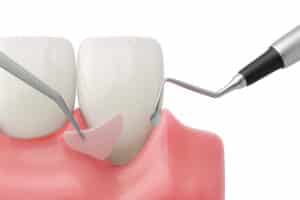 cerritos gum grafting