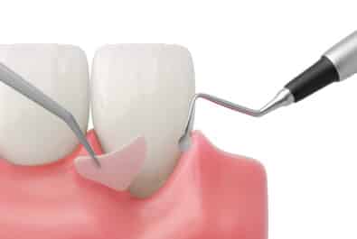 cerritos gum grafting