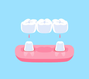 cerritos dental bridges