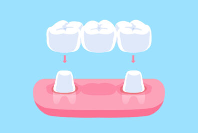 cerritos dental bridges