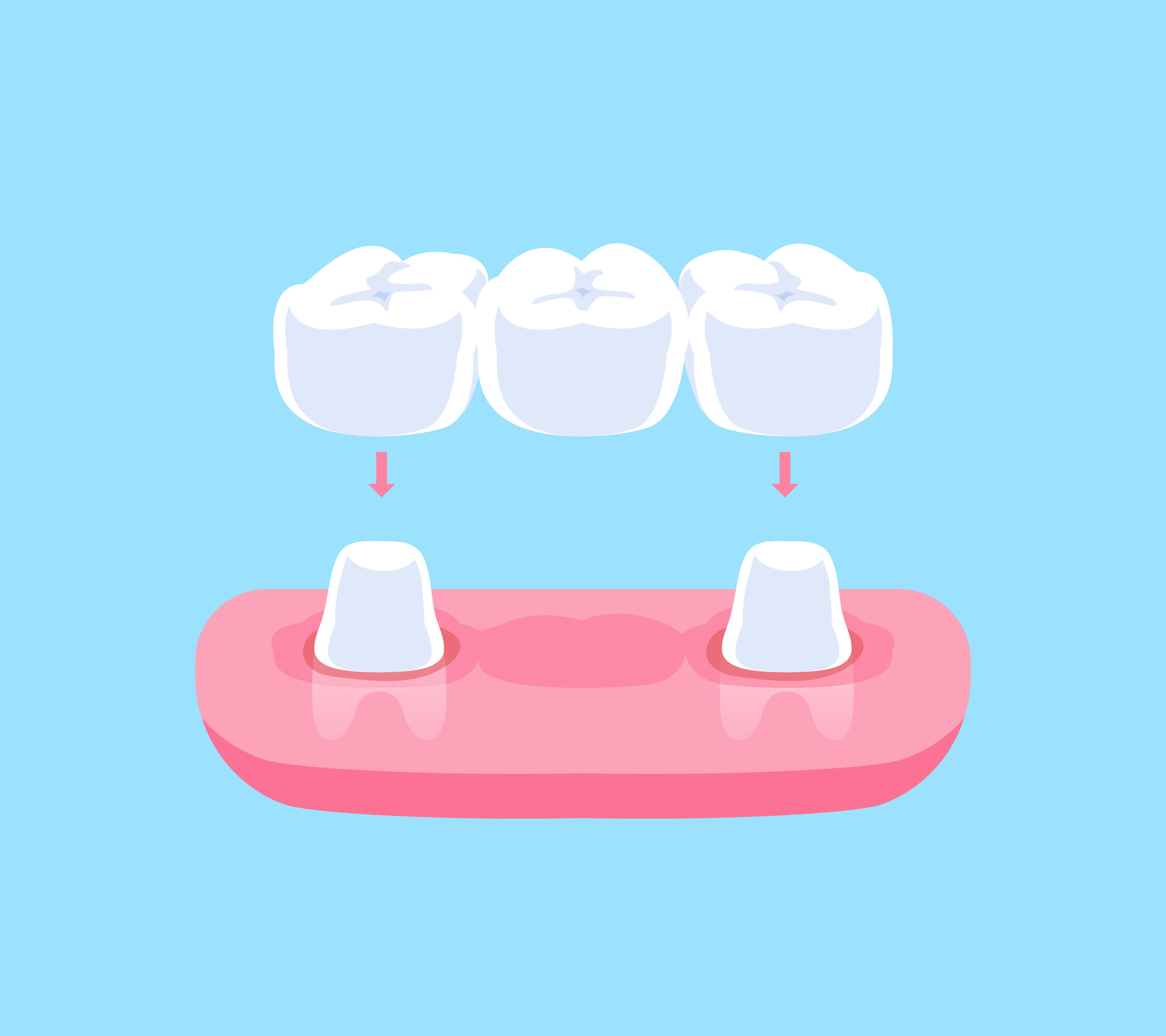 cerritos dental bridges