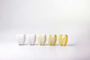 cerritos teeth whitening