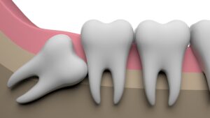cerritos wisdom tooth extraction