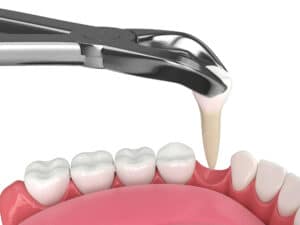 cerritos tooth extraction