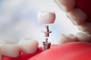 cerritos jawbone grafting 