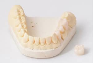 cerritos ceramic crown